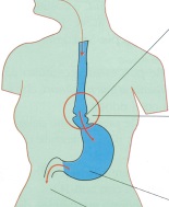 Reflusso, endoscopie del tratto digestivo superiore spesso inappropriate